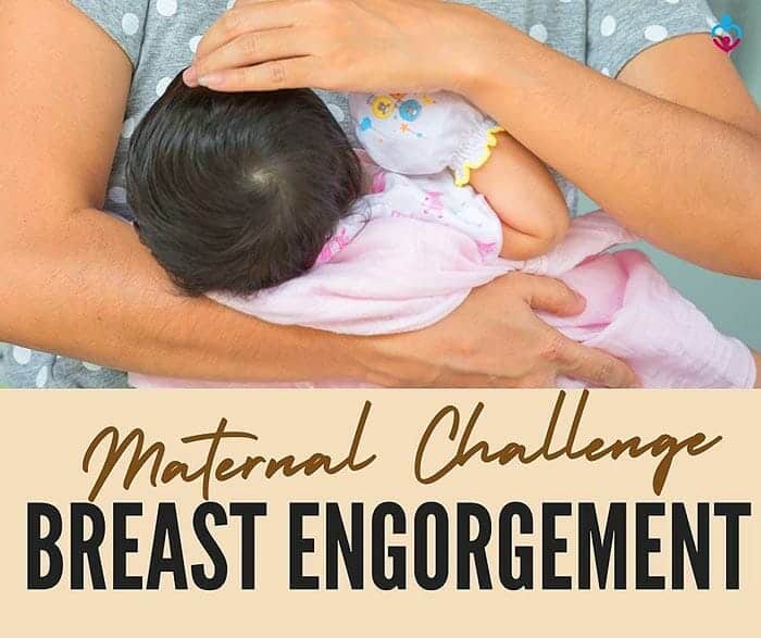 Breast Engorgement Maternal Lactation Problem