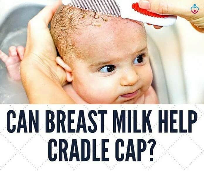 Can Breast Milk Help Cradle Cap?