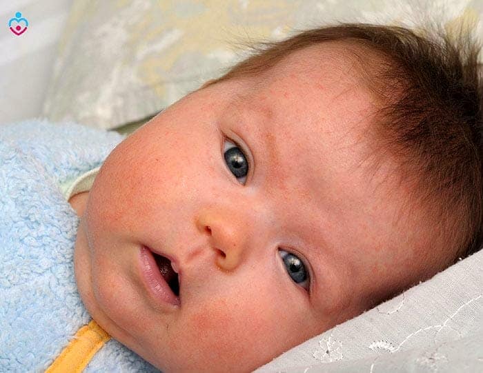 Signs Baby Allergic To Breastmilk
