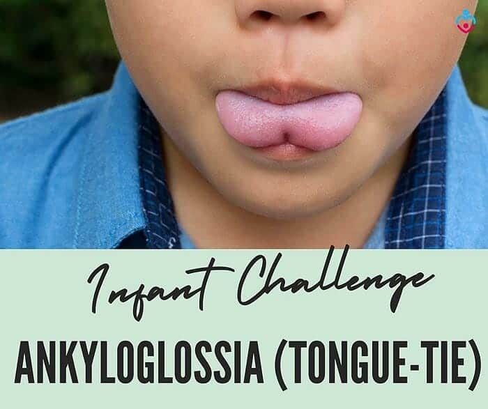 Tongue-Tie and Breastfeeding